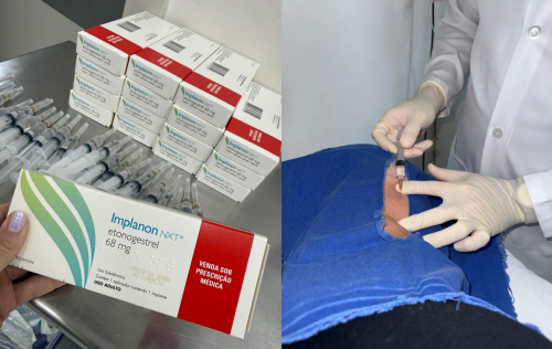 Mutirão da Secretaria de Saúde amplia acesso a métodos contraceptivos e reduz fila de espera em Erechim